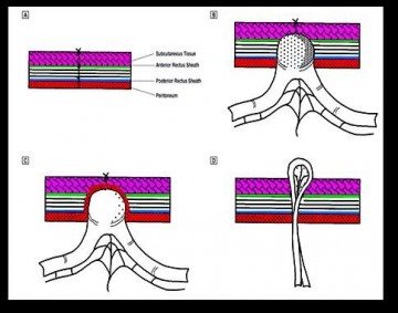 Classification of the 3 trocar site hernias A Normal stab wound of trocar site B