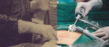 evolucion laparoscopia